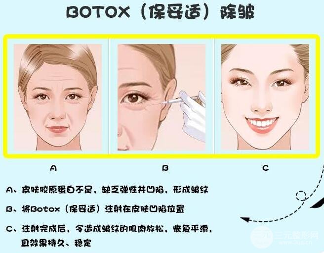 注射瘦脸