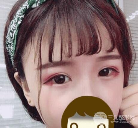 重慶大坪醫(yī)院割雙眼皮怎么樣