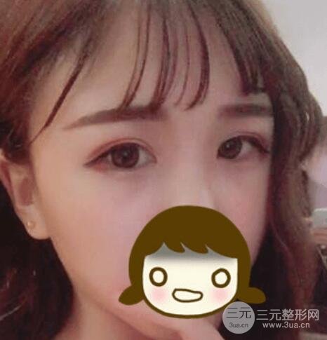 重慶大坪醫(yī)院魯元剛雙眼皮案例