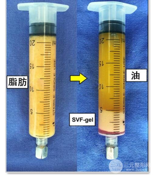 脂肪填充太阳穴手术的危害