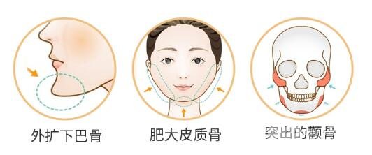磨骨手术真的很可怕吗?