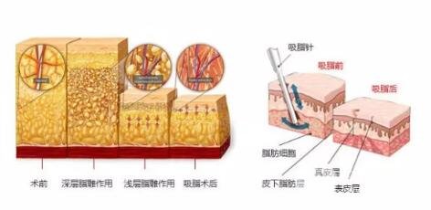 臀部吸脂手术是否有副作用?