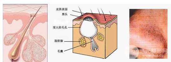 激光去黑头需要几次？基本与“草莓鼻”说拜拜~