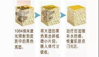 激光去黑头需要几次？基本与“草莓鼻”说拜拜~