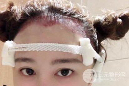 南方醫(yī)科大學(xué)南方醫(yī)院植發(fā)果圖