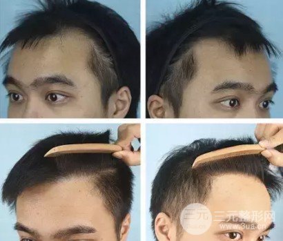 南方醫(yī)科大學(xué)南方醫(yī)院植發(fā)果圖