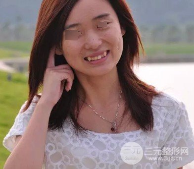 2020南京口腔醫(yī)院虎牙正畸果圖