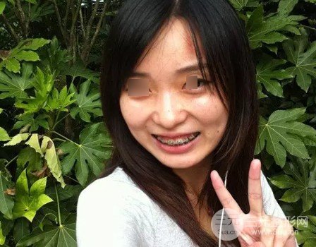 2020南京口腔醫(yī)院虎牙正畸果圖