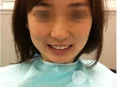 2020南京口腔醫(yī)院虎牙正畸果圖