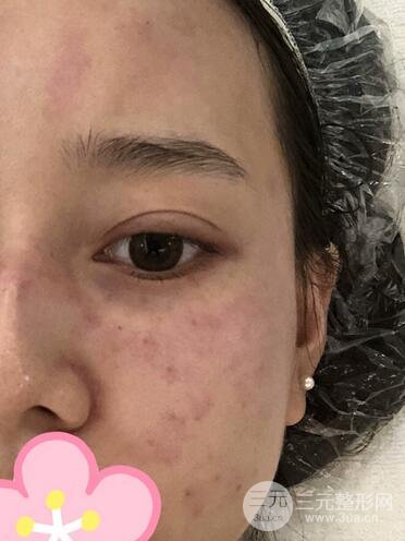 北京協(xié)和醫(yī)院美容皮膚科祛斑果圖