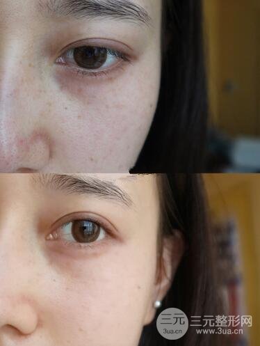 北京協(xié)和醫(yī)院美容皮膚科祛斑果圖