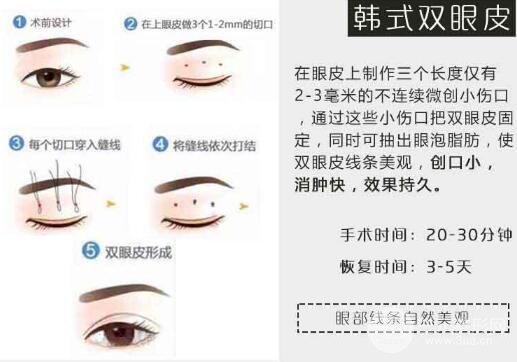 徐醫(yī)附院美容整容醫(yī)院割雙眼皮技術(shù)