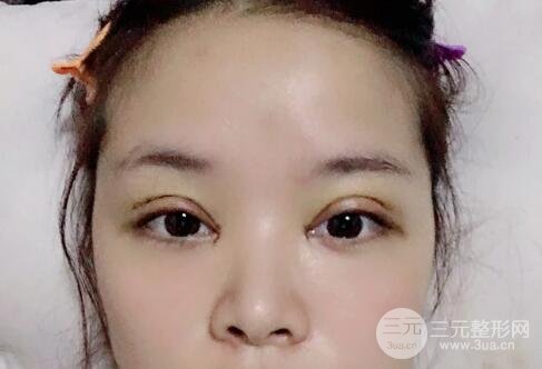 徐醫(yī)附院美容整容醫(yī)院雙眼皮案例一