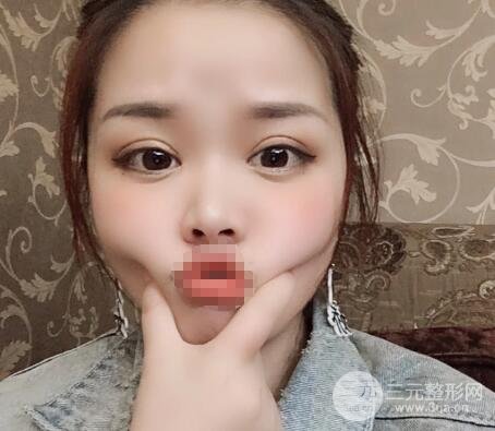 徐醫(yī)附院美容整容醫(yī)院割雙眼皮多少錢