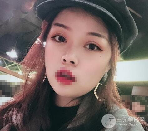 徐醫(yī)附院美容整容醫(yī)院雙眼皮案例圖