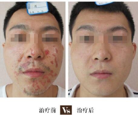 昆醫(yī)附二院美容整形祛疤案例