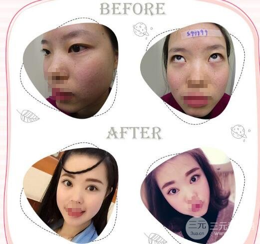 安醫(yī)二附院整形美容中心雙眼皮案例