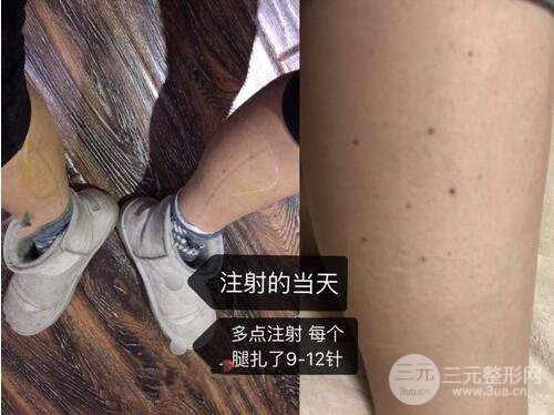 注射瘦腿果图