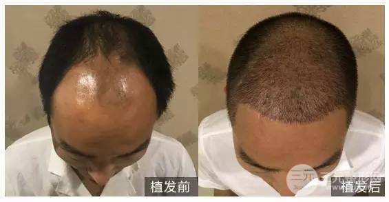 种植头发果图