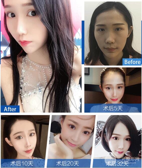 飞顿光子嫩肤果图