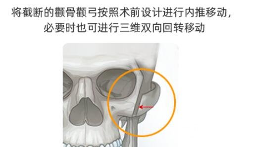 颧骨内推手术风险大吗?