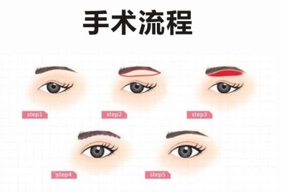 眉弓脂肪填充注意事项