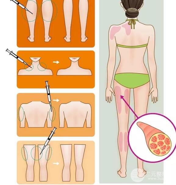大腿吸脂手术术后后遗症以及避开后遗症发生的要点!