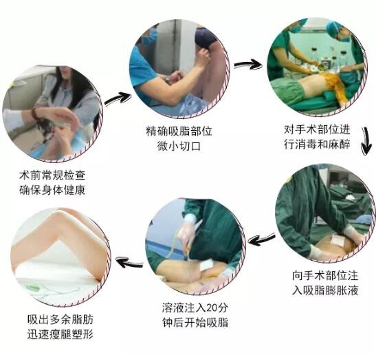 大腿吸脂手术后遗症有哪些?