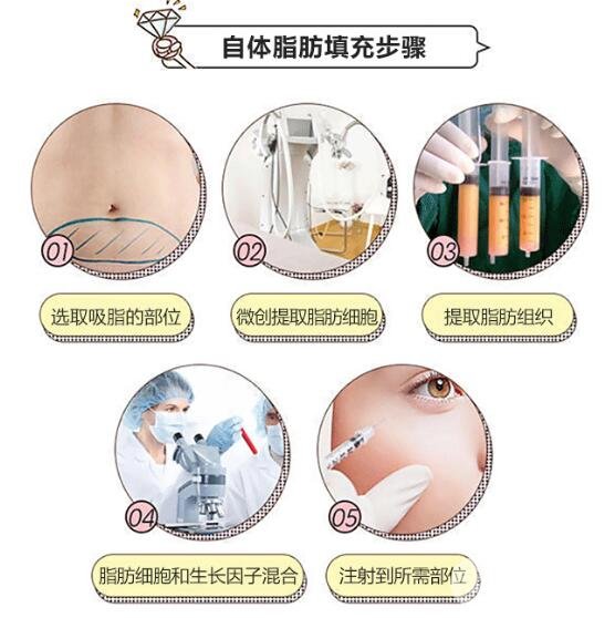 脂肪填充的优势有哪些?