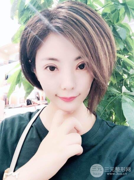 柳州人民醫(yī)院雙眼皮