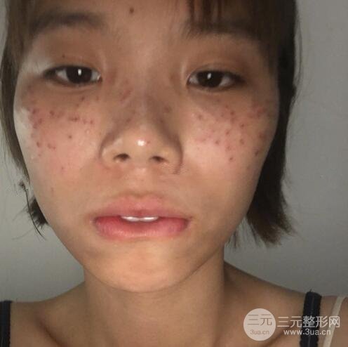 祛斑案例