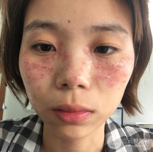 祛斑案例