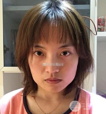 下頜骨磨骨案例