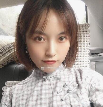 下頜骨切除案例