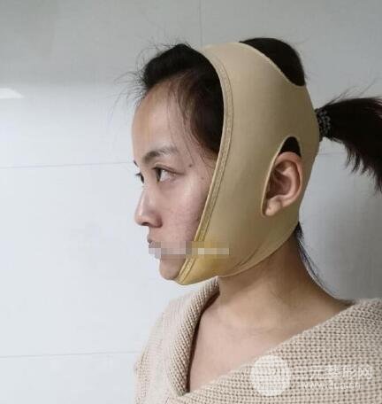 下頜骨切除案例