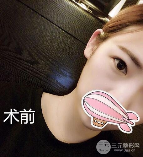 醫(yī)雙眼皮案例