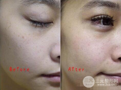 祛斑案例
