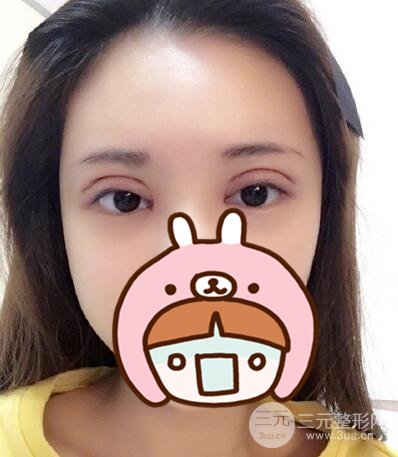 全切雙眼皮手術(shù)案例