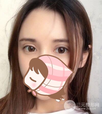 全切雙眼皮手術(shù)案例