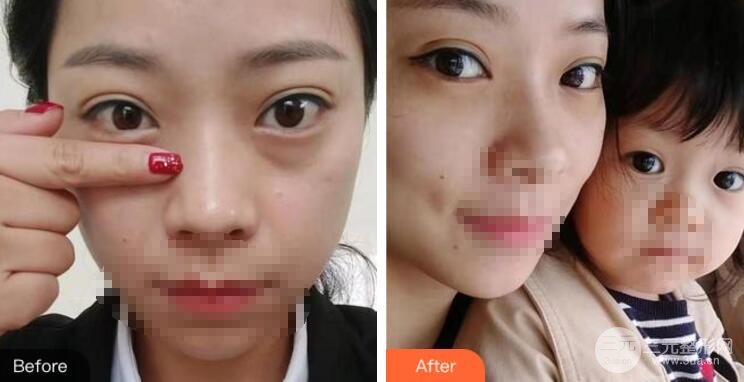 外切去眼袋果图