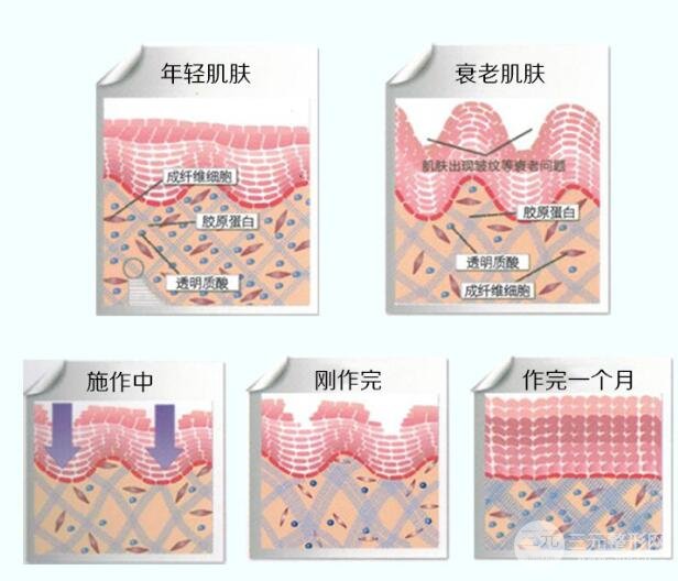拉皮手术收费标准