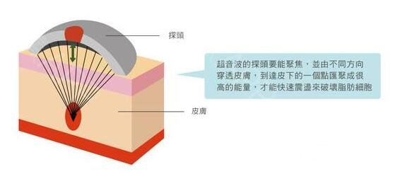 超声吸脂