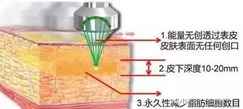 共振吸脂