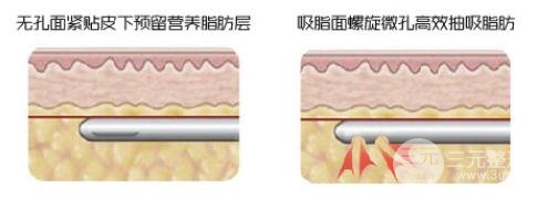 注射吸脂