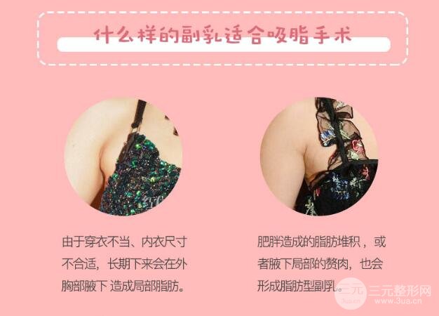 腋下副乳手术多少钱?腋下副乳手术价格分析!