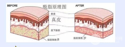 为什么会出现腋下副乳?