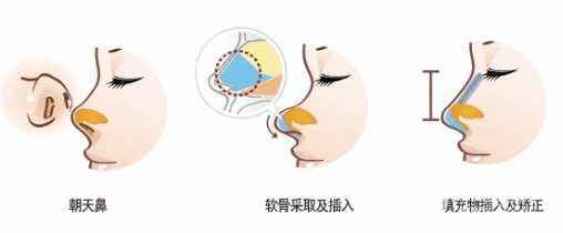 朝天鼻整容保持一辈子吗？前后照片对比惊艳！