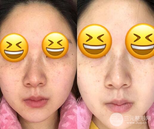 opt嫩肤果图
