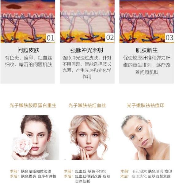 opt嫩肤是什么?果图看着太舒服了!