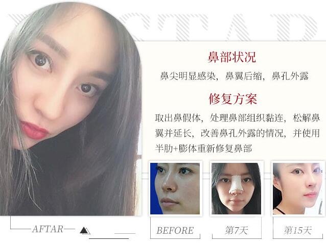 注射隆鼻的修复果图